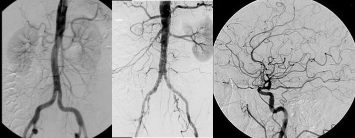 Digitalen Subtraktionsangiographie (DSA) von Bauch und Kopf
