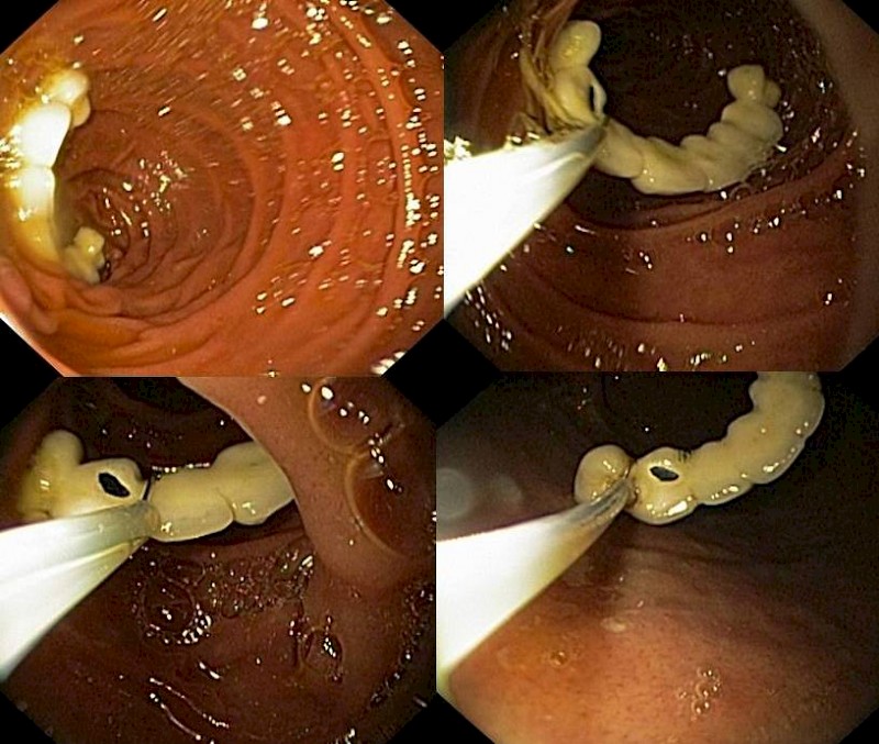 Endoskopische Extraktion der Zahnprothese aus dem Duodenum