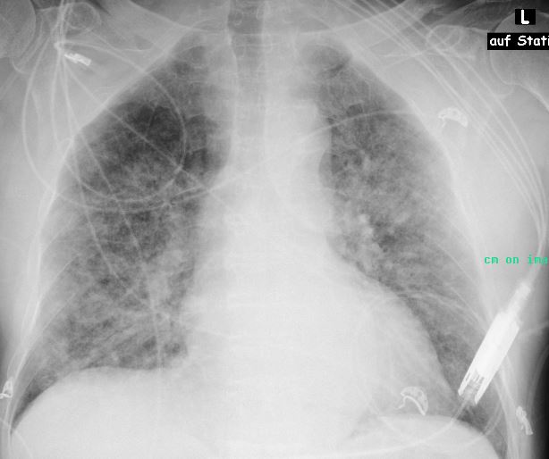 Das Röntgenbild des Thorax (Aufnahme unter Intensivbedingungen) zeigt ein ausgeprägtes Lungenödem.